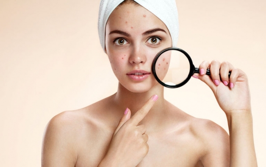 Η ακμή στην εφηβεία